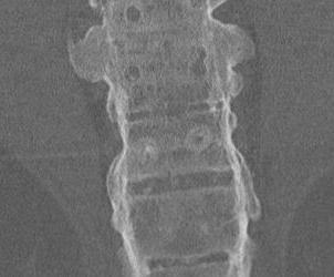 Ankylosing Spondylitis CT Spine Coronal